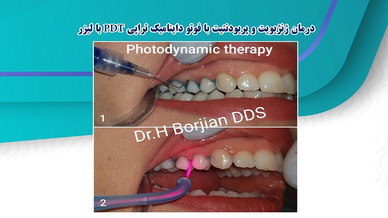 درمان ژنژیویت و پریودنتیت با فوتو داینامیک تراپی PDT با لیزر | لیزر دندانپزشکی اصفهان