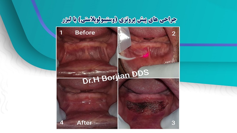 جراحی های پیش پروتزی (وستیبولوپلاستی) با لیزر | لیزر دندانپزشکی اصفهان