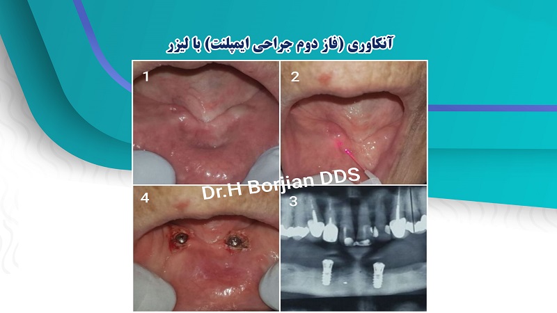 آنکاوری (فاز دوم جراحی ایمپلنت) با لیزر | لیزر دندانپزشکی اصفهان