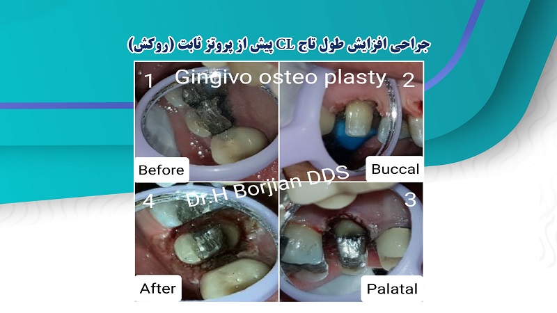 جراحی افزایش طول تاج CL پیش از پروتز ثابت (روکش) | لیزر دندانپزشکی اصفهان