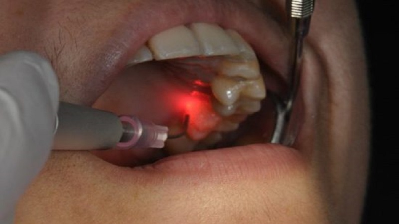 بیماری های دندانی قابل درمان با لیزر | لیزر دندان اصفهان