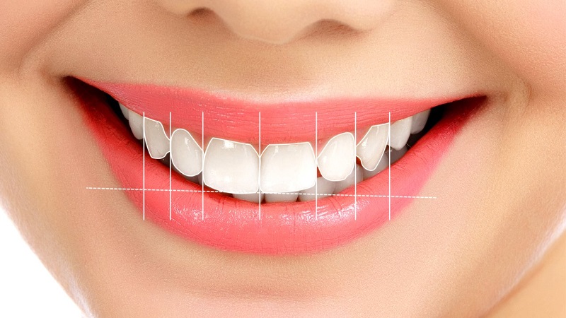 اصلاح خط لبخند و مرتب کردن دندان بدون ارتودنسی | جراحی لثه با لیزر