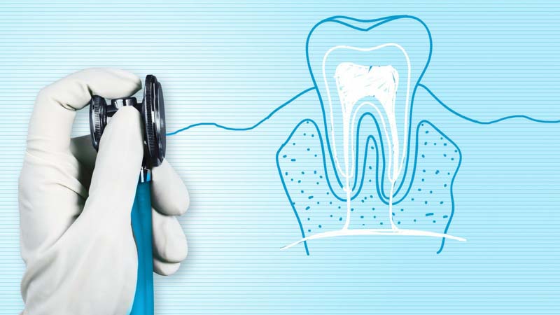 مزایا و عوارض درمان ریشه دندان با لیزر | لیزر دندانپزشکی اصفهان