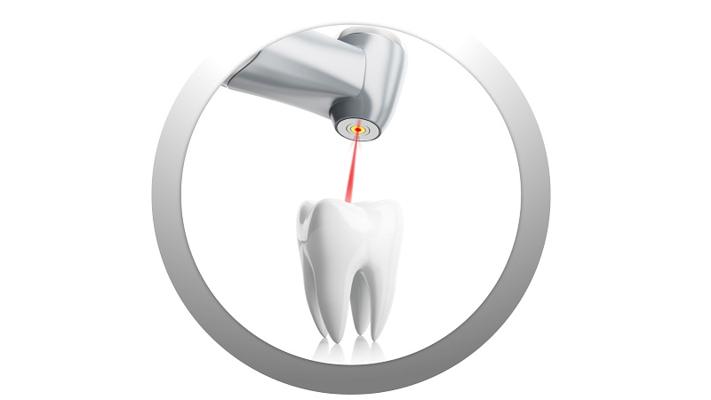تاریخچه دندانپزشکی لیزری | لیزر دندانپزشکی اصفهان