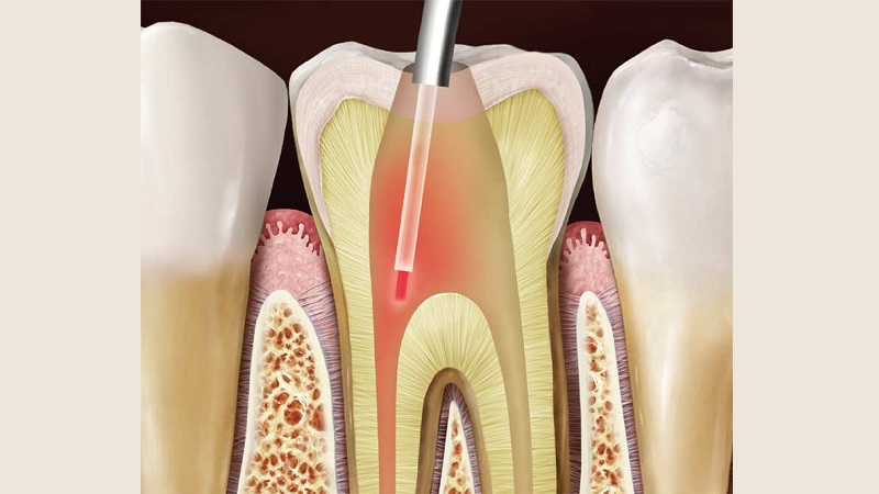 رفع پوسیدگی و ترمیم دندان با لیزر | جراحی لثه با لیزر