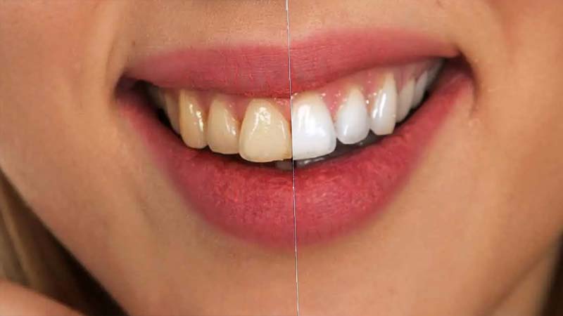 عوامل ایجاد تغییر رنگ دندان | طرح لبخند اصفهان