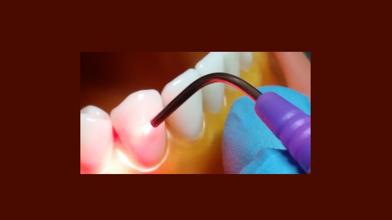 قدرت لیزرهای اربیوم در دندانپزشکی | لیزر دندانپزشکی اصفهان