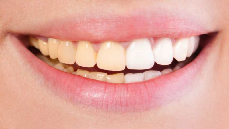عوارض بلیچینگ دندان | لیزر دندانپزشکی اصفهان