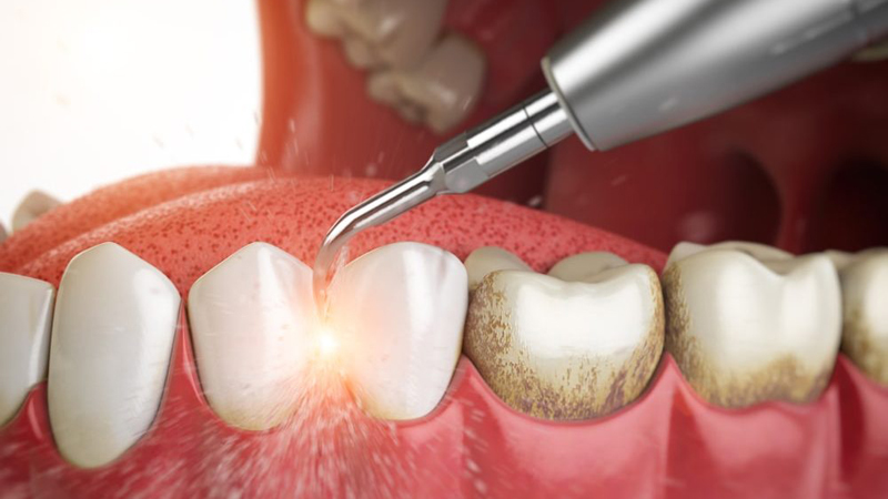 پیشگری از تشکیل و درمان پلاک دندان | لیزر دندانپزشکی اصفهان