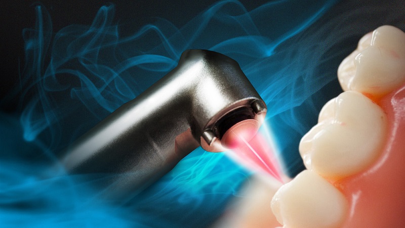 تاثیر لیزرهای دندانی بر بهبود زخم دهان | لیزر دندانپزشکی اصفهان