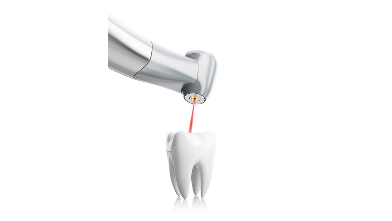 درمان عفونت دندان با فناوری لیزر | لیزر دندانپزشکی اصفهان