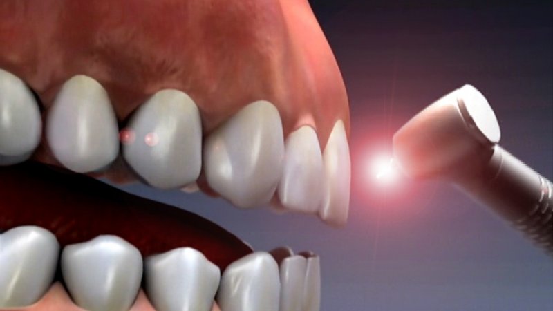 تراش حفره و برداشت پوسیدگی دندان با لیزر | لیزر دندانپزشکی اصفهان