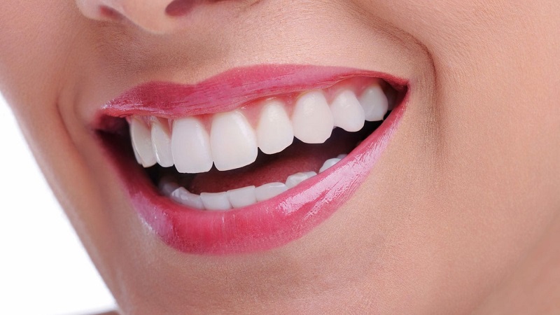 مقایسه بلیچینگ دندان در خانه و مطب | طرح لبخند اصفهان