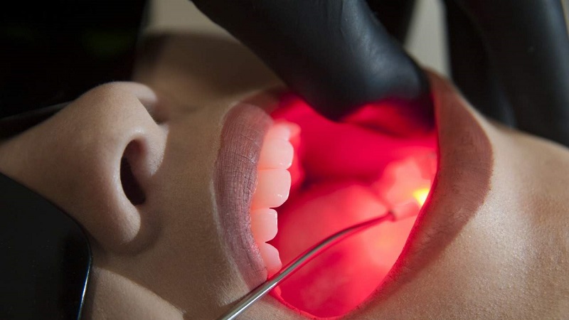 سرعت بهبودی دندان با لیزر دندانپزشکی | لیزر دندانپزشکی اصفهان