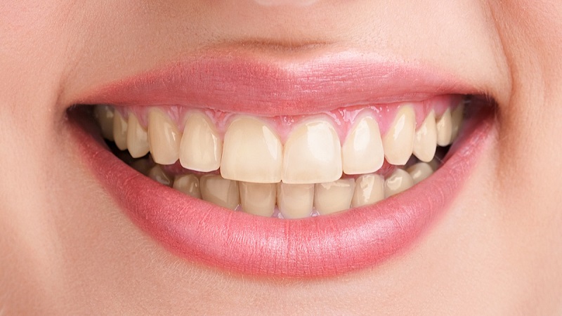 دلایل تغییر رنگ لمینت دندان | طرح لبخند اصفهان