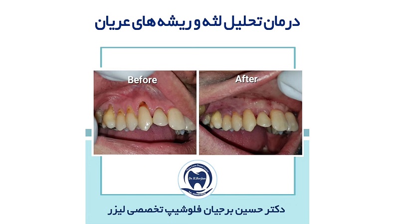 نمونه درمان تحلیل لثه و ریشه های عریان | طرح لبخند اصفهان
