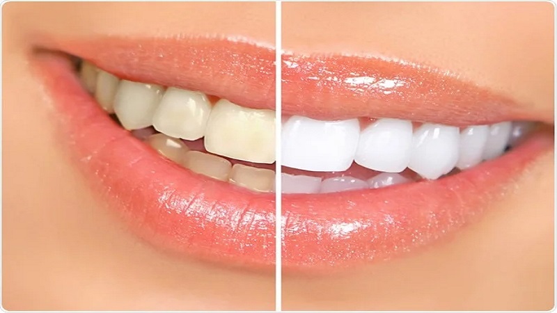 بلیچینگ دندان چیست؟ | لیزر دندانپزشکی اصفهان - طرح لبخند اصفهان