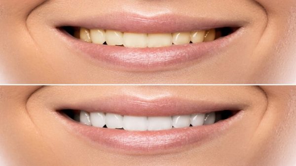 بلیچینگ دندان چیست؟ | لیزر دندانپزشکی اصفهان - 
طرح لبخند اصفهان