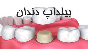 بهترین مواد برای بیلداپ دندان | لیزر دندانپزشکی اصفهان - طرح لبخند اصفهان