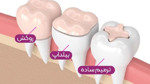بیلد آپ یا بازسازی دندان چیست؟ | لیزر دندانپزشکی اصفهان - 
طرح لبخند اصفهان