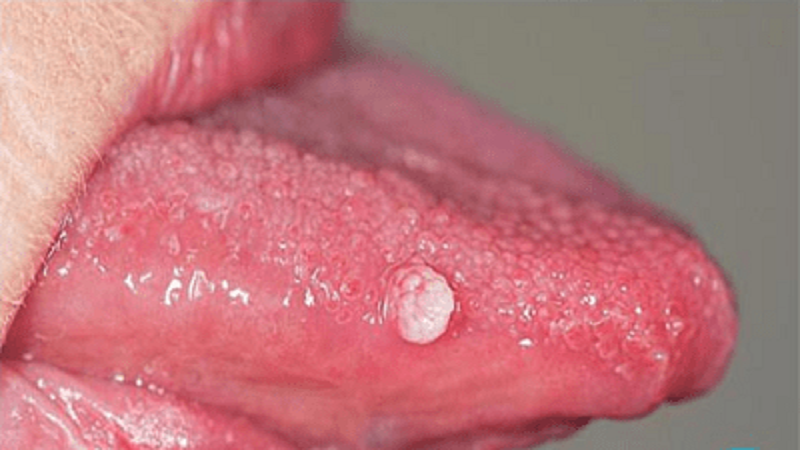 آیا ویروس HPV از طریق بوسیدن منتقل می‌شود؟ | لیزر دندانپزشکی اصفهان - طرح لبخند اصفهان