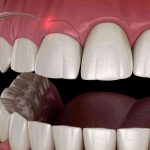 در چه مواقعی لیفت لثه نیاز است؟ | لیزر دندانپزشکی اصفهان - طرح لبخند اصفهان