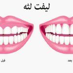 انواع لیفت لثه | لیزر دندانپزشکی اصفهان - طرح لبخند اصفهان