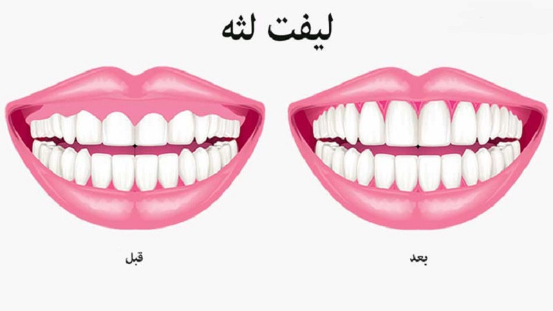 در چه مواقعی لیفت لثه نیاز است؟ | لیزر دندانپزشکی اصفهان -
طرح لبخند اصفهان