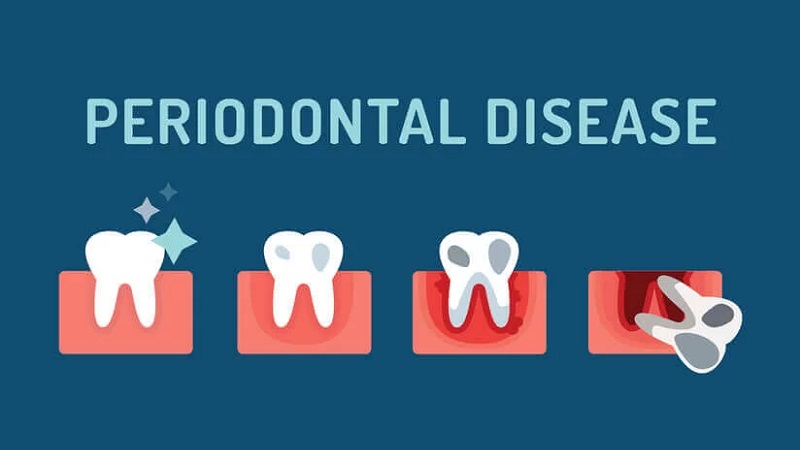 تأثیر تلفیق لیزر دندانپزشکی با تکنیک‌های سنتی درمان بیماری‌های پریودنتال | لیزر دندانپزشکی اصفهان | دکتر حسین برجیان