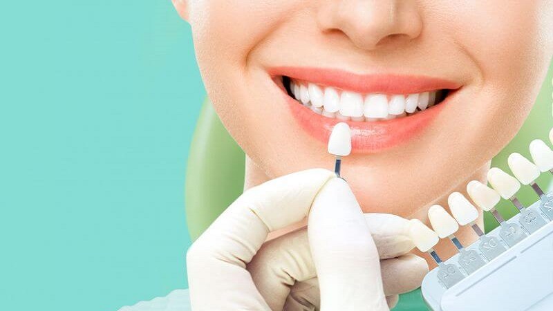 نقش لیزر در بهبود ماندگاری و کیفیت لمینت‌های دندانی | طرح لبخند اصفهان | دکتر حسین برجیان