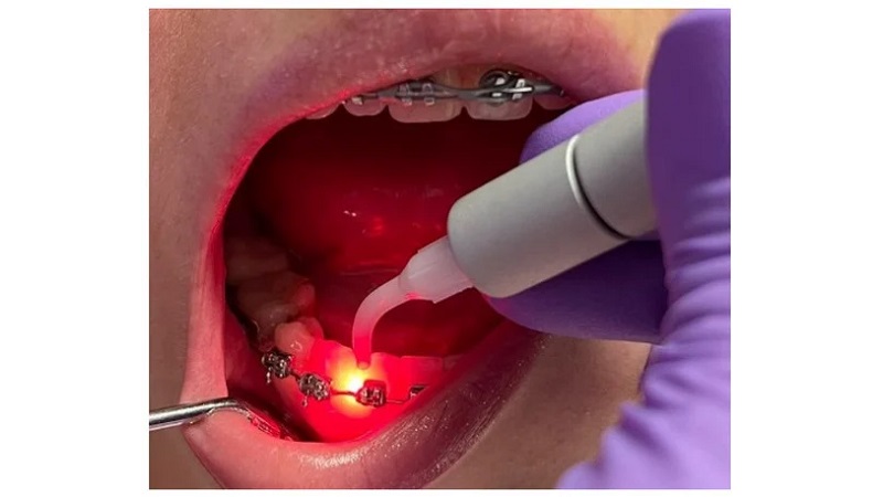 طول عمر دندان در عصر فناوری لیزر | دکتر حسین برجیان | لیزر دندانپزشکی اصفهان