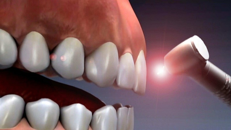 تفاوت لیزر دندانپزشکی و جراحی لثه | لیزر دندانپزشکی اصفهان - طرح لبخند اصفهان | دکتر حسین برجیان