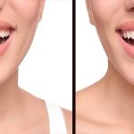 چه کسانی نیاز به لیفت لثه دارند؟ | اصلاح طرح لبخند با جراحی لثه, اصلاح لبخند لثه‌ای, بلیچینگ دندان, بهترین دندانپزشک اصفهان, دکتر حسین برجیان, لیزر دندانپزشکی اصفهان