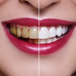 مراقبت‌های بعد از بلیچینگ | اصلاح طرح لبخند با جراحی لثه, اصلاح لبخند لثه‌ای, بلیچینگ دندان, بهترین دندانپزشک اصفهان, دکتر حسین برجیان, لیزر دندانپزشکی اصفهان
