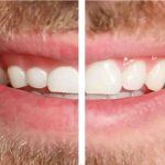 نتیجه‌ی لیفت لثه چقدر ماندگار است؟ | اصلاح طرح لبخند با جراحی لثه, اصلاح لبخند لثه‌ای, بلیچینگ دندان, بهترین دندانپزشک اصفهان, دکتر حسین برجیان, لیزر دندانپزشکی اصفهان