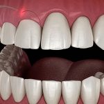 مدت زمان و مراحل انجام لیفت لثه | اصلاح طرح لبخند با جراحی لثه, اصلاح لبخند لثه‌ای, بلیچینگ دندان, بهترین دندانپزشک اصفهان, دکتر حسین برجیان, لیزر دندانپزشکی اصفهان