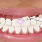 هزینه لیفت لثه چقدر است؟ | اصلاح طرح لبخند با جراحی لثه, اصلاح لبخند لثه‌ای, بلیچینگ دندان, بهترین دندانپزشک اصفهان, دکتر حسین برجیان, لیزر دندانپزشکی اصفهان