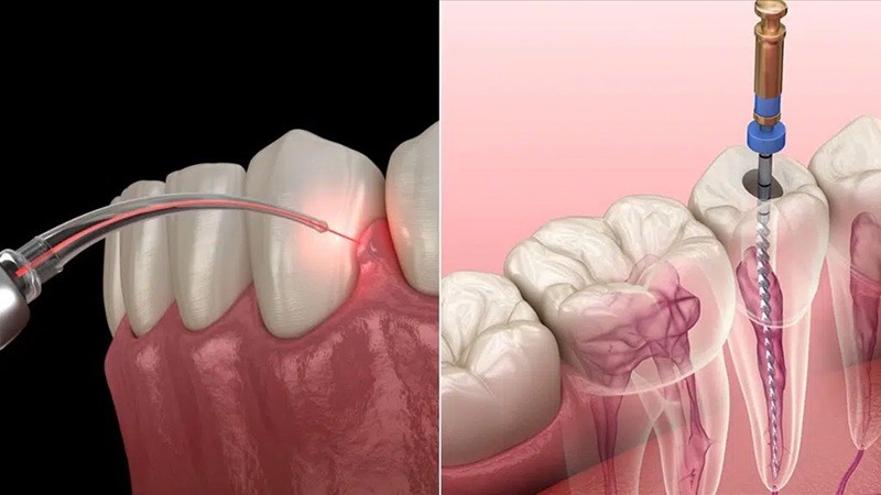 کاربرد لیزر در درمان ریشه کلسیفیه شده (Calcified Canal) | لیزر دندانپزشکی اصفهان - طرح لبخند اصفهان | دکتر حسین برجیان