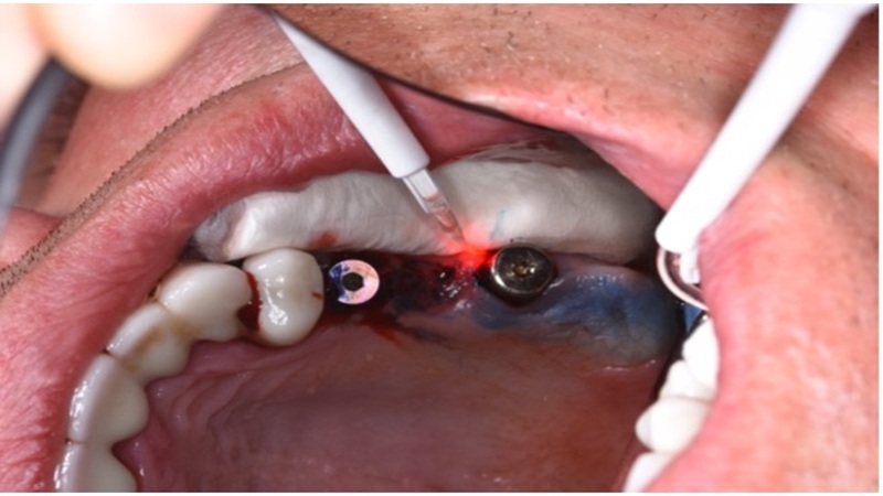 کاربرد لیزر در درمان التهاب اطراف ایمپلنت (Peri-Implant Mucositis) | لیزر دندانپزشکی اصفهان - طرح لبخند اصفهان | دکتر حسین برجیان
