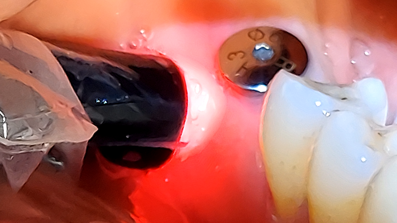 کاربرد لیزر در درمان التهاب اطراف ایمپلنت (Peri-Implant Mucositis) | لیزر دندانپزشکی اصفهان - طرح لبخند اصفهان | دکتر حسین برجیان