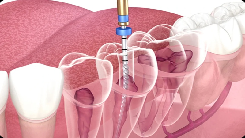 کاربرد لیزر در درمان ریشه کلسیفیه شده (Calcified Canal) | لیزر دندانپزشکی اصفهان - طرح لبخند اصفهان | دکتر حسین برجیان