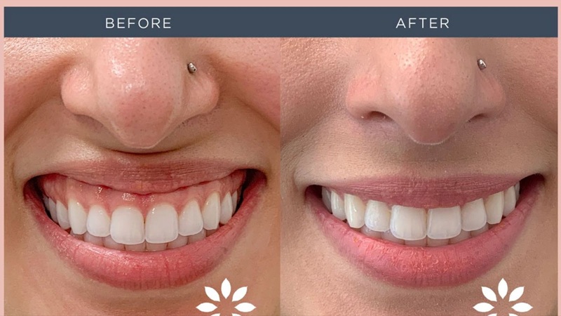 کاربرد لیزر در درمان لبخند لثه‌ای (Gummy Smile) | لیزر دندانپزشکی اصفهان - طرح لبخند اصفهان | دکتر حسین برجیان