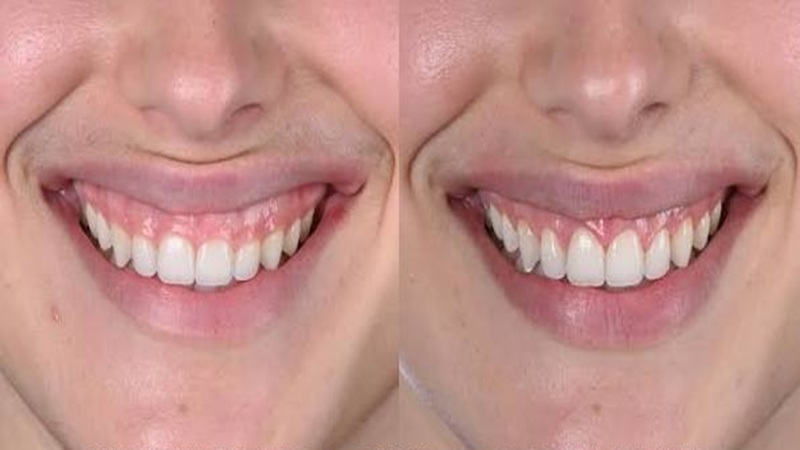کاربرد لیزر در درمان لبخند لثه‌ای (Gummy Smile) | لیزر دندانپزشکی اصفهان - طرح لبخند اصفهان | دکتر حسین برجیان