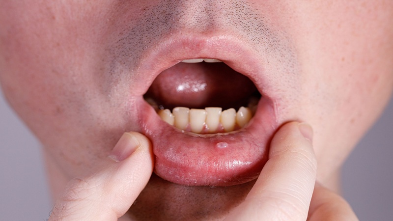 کاربرد لیزر در درمان موکوسل (Mucocele) | لیزر دندانپزشکی اصفهان | طرح لبخند اصفهان | بلیچینگ دندان اصفهان | دکتر حسین برجیان