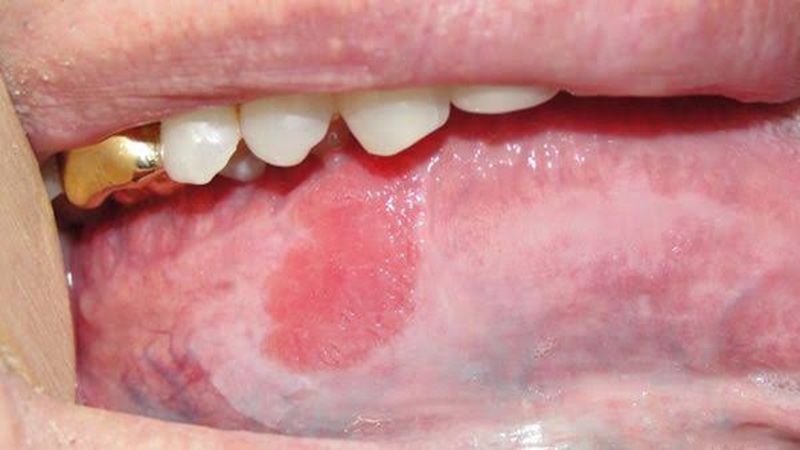 کاربرد لیزر در درمان اریترپلاکیا دهان (Oral Erythroplakia) | لیزر دندانپزشکی اصفهان | طرح لبخند اصفهان | بلیچینگ دندان اصفهان | دکتر حسین برجیان