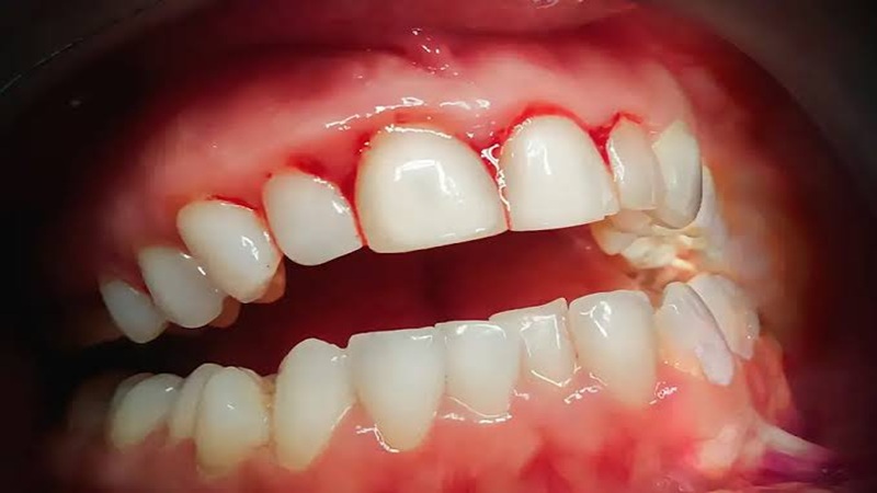  کنترل التهاب و کاهش بار میکروبی زیر پروتزهای دندانی | لیزر دندانپزشکی اصفهان | طرح لبخند اصفهان | بلیچینگ دندان اصفهان | دکتر حسین برجیان