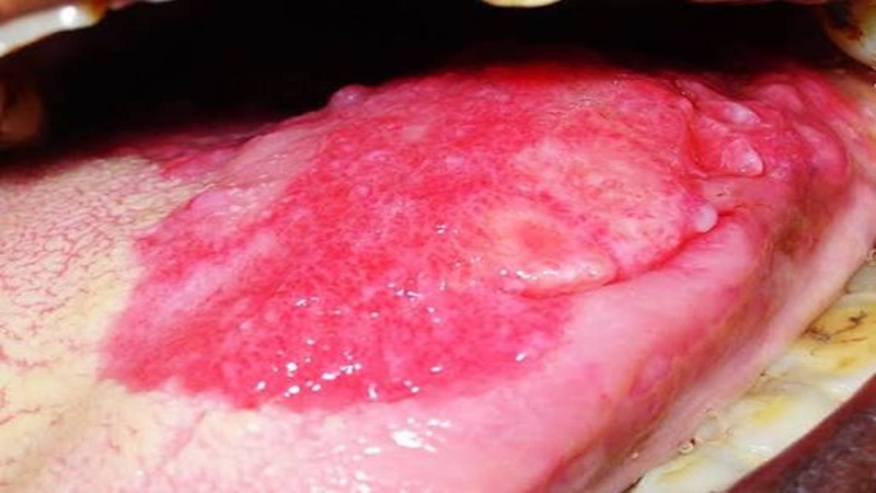 کاربرد لیزر در درمان اریترپلاکیا دهان (Oral Erythroplakia) | لیزر دندانپزشکی اصفهان | طرح لبخند اصفهان | بلیچینگ دندان اصفهان | دکتر حسین برجیان