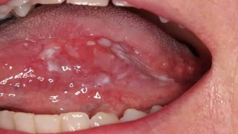 کاربرد لیزر در درمان لوکوپلاکیا دهان (Oral Leukoplakia) | لیزر دندانپزشکی اصفهان | طرح لبخند اصفهان | بلیچینگ دندان اصفهان | دکتر حسین برجیان