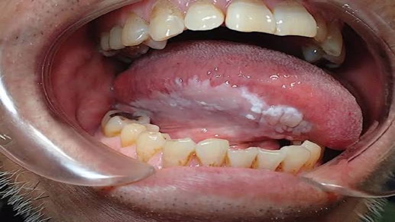 کاربرد لیزر در درمان لوکوپلاکیا دهان (Oral Leukoplakia) | لیزر دندانپزشکی اصفهان | طرح لبخند اصفهان | بلیچینگ دندان اصفهان | دکتر حسین برجیان