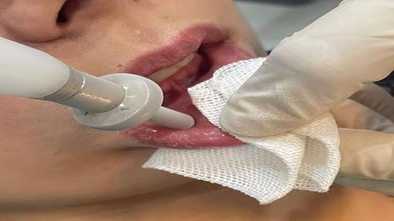 کاربرد لیزر در درمان موکوسل (Mucocele) | لیزر دندانپزشکی اصفهان | طرح لبخند اصفهان | بلیچینگ دندان اصفهان | دکتر حسین برجیان